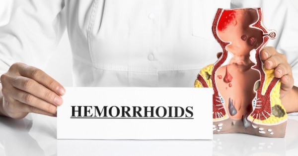 ᐉ What are external hemorrhoids? - Benepura.com