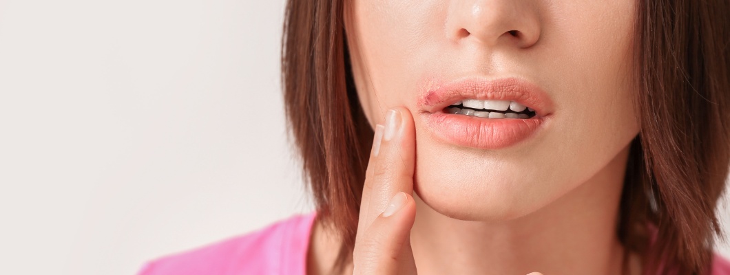 Cold Sores: How to recognize and Treat them in time