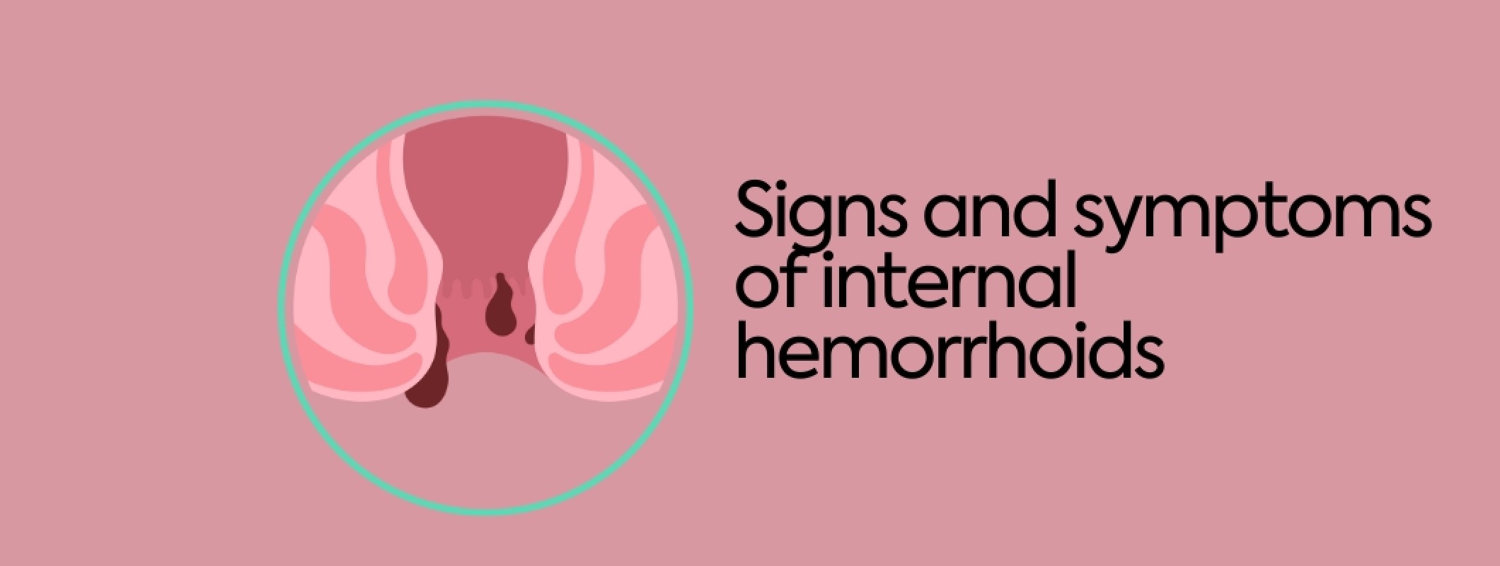 ᐉ Signs and symptoms of internal hemorrhoids - Benepura.com