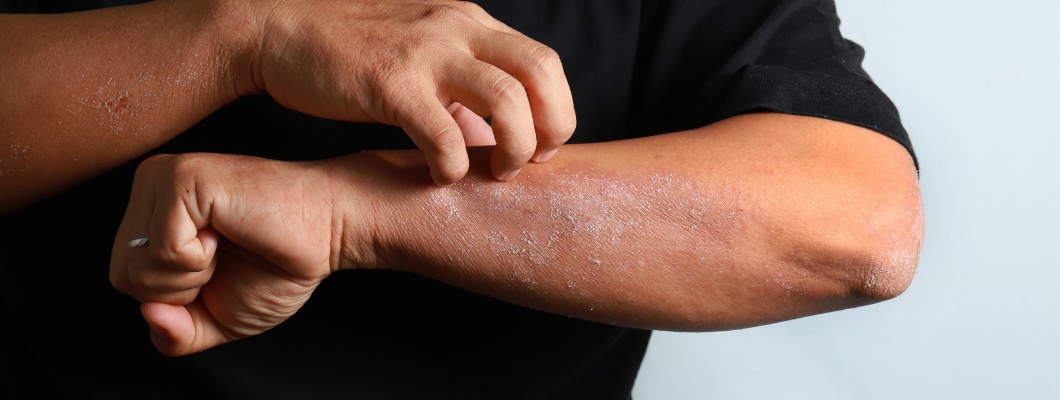 Eczema: How to Recognize and Treat It Effectively