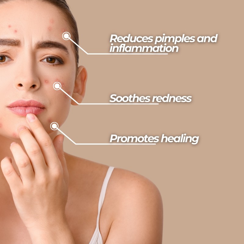 Natural face cream for Acne - 50ml