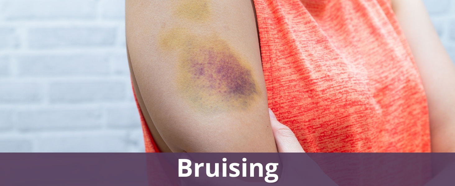 Bruising