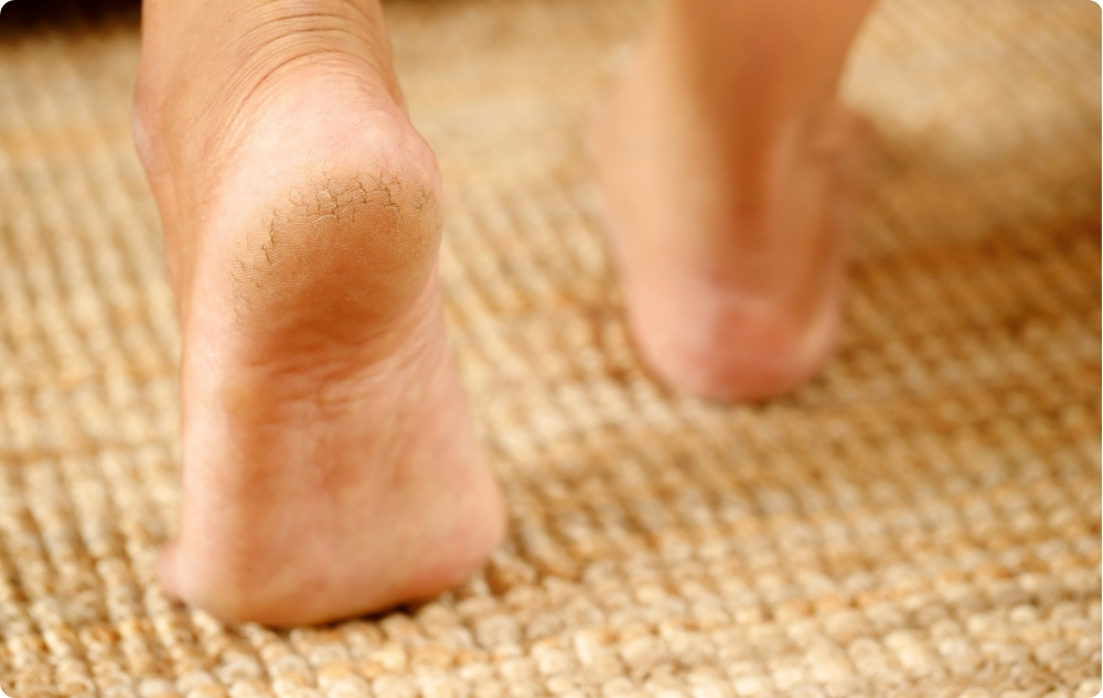 As a softening oil for cracked heels and elbows