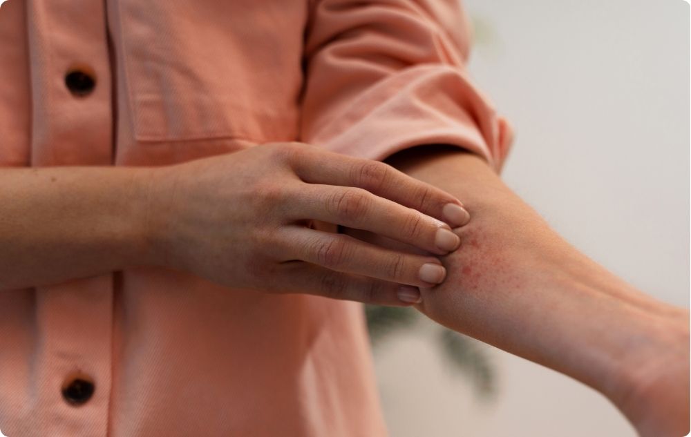 Treatment of eczema and dermatitis