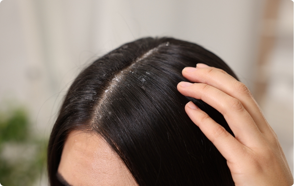 As a scalp lotion against dandruff and hair loss