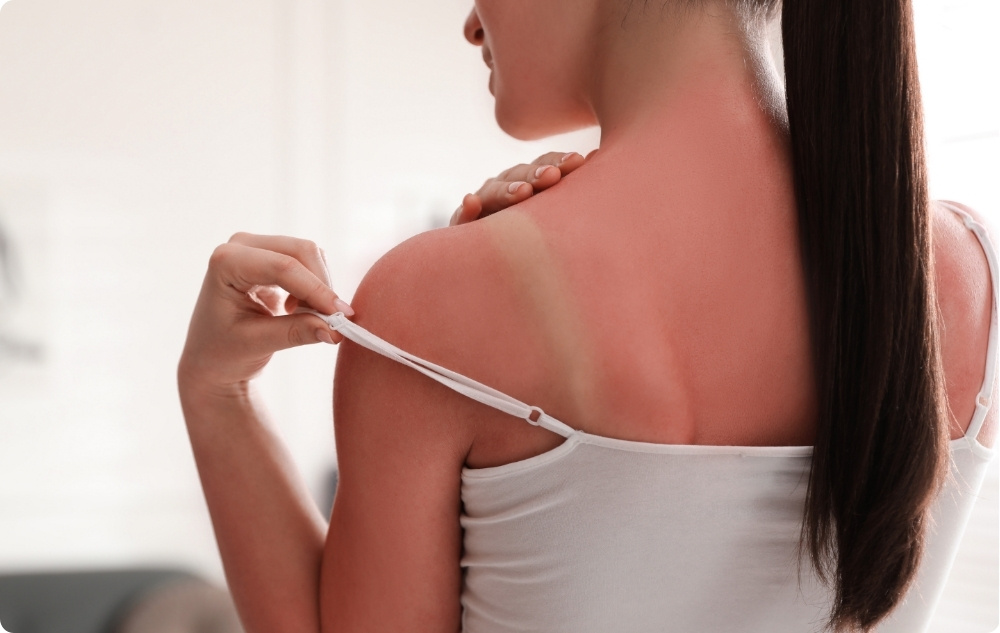As an after-sunburn oil